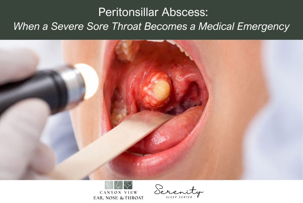 Peritonsillar Abscess When a Severe Sore Throat Becomes a Medical Emergency