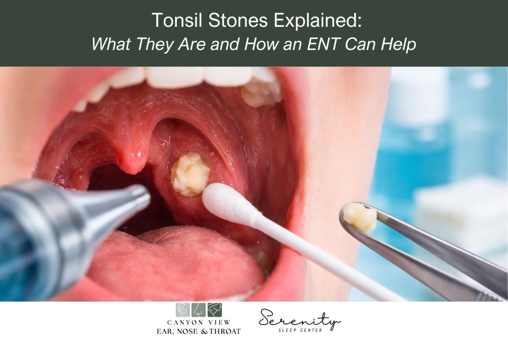 Tonsil Stones Explained: What They Are and How an ENT Can Help